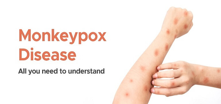 Monkeypox Disease : All You Need to Understand
