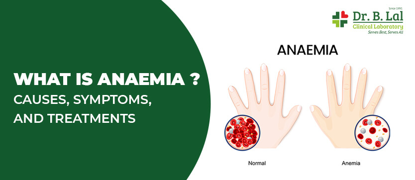 What is Anaemia? Causes, Symptoms, and Treatments