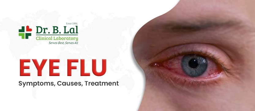 Eye Flu - Symptoms, Causes and Treatment at Home