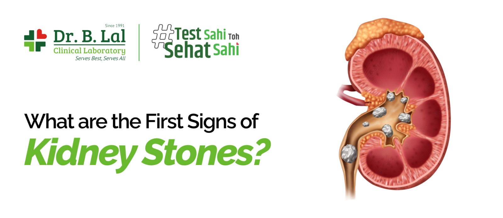 What are the First Signs of Kidney Stones?