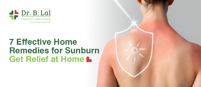  7 Effective Home Remedies for Sunburn - Get Relief at Home